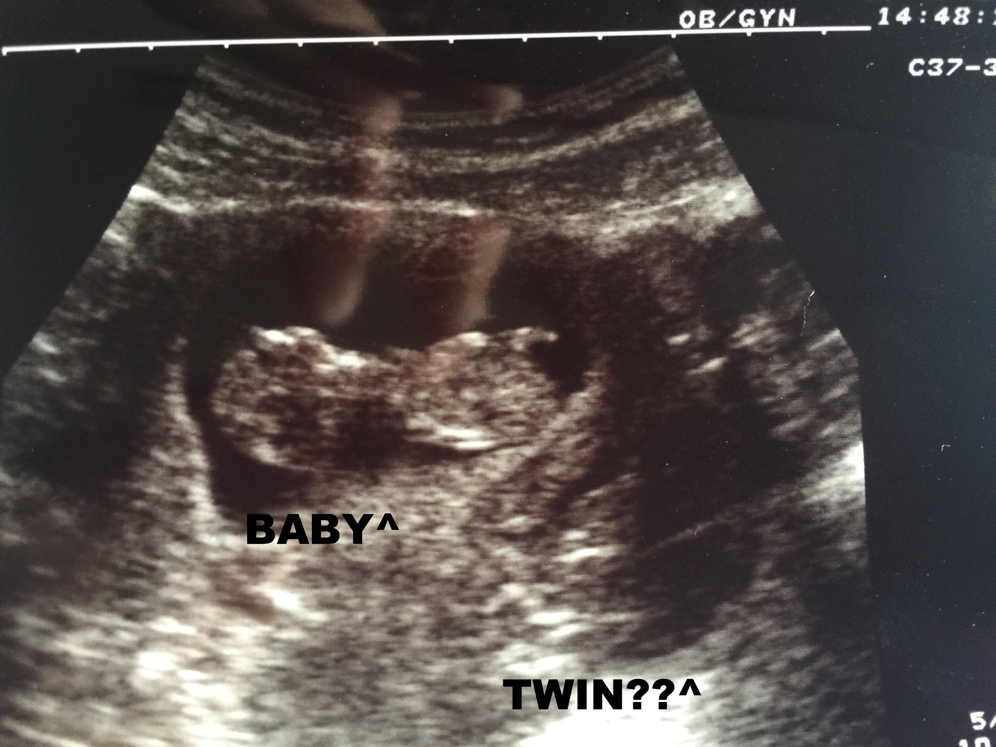 Hidden Twin At 9 Week Ultrasound