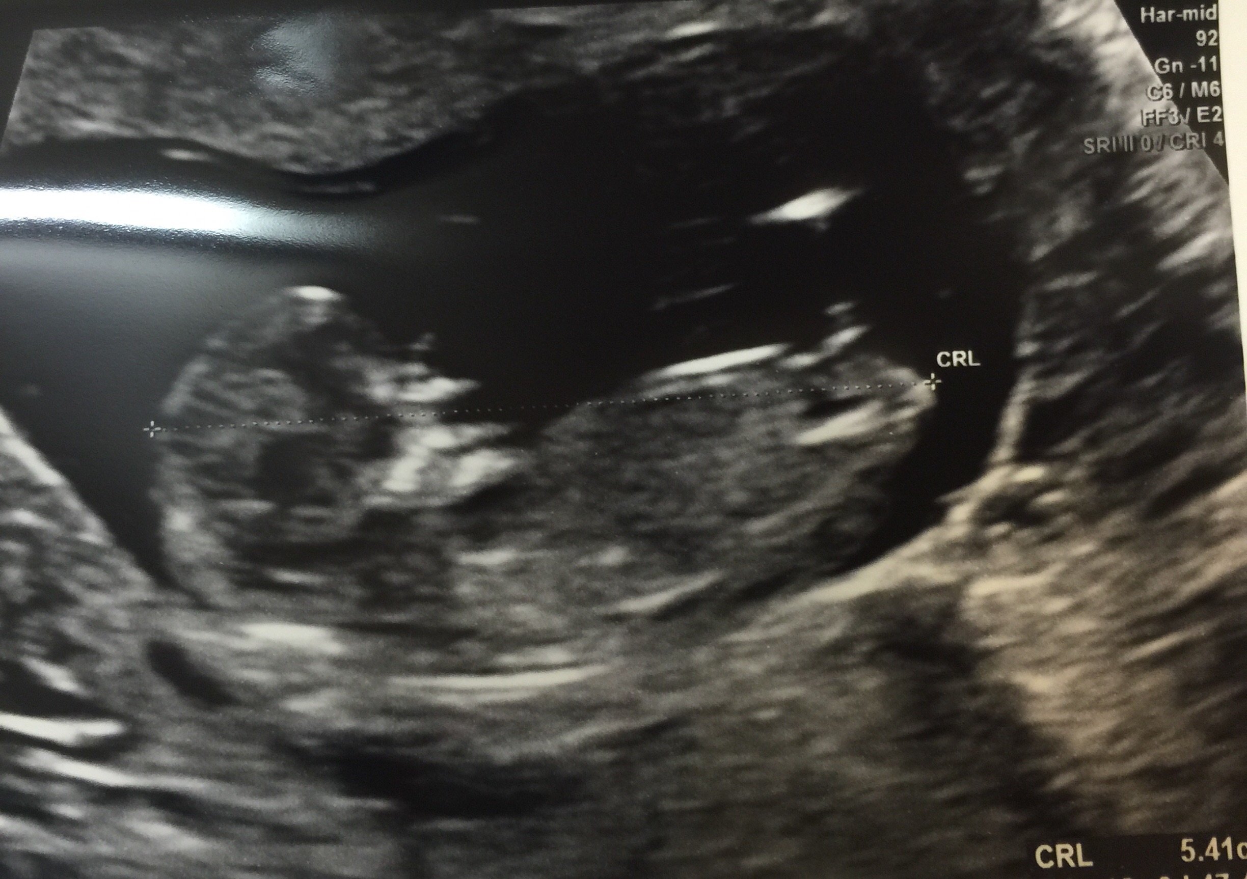 4Ab Embryo Gender:  What The Experts Say - qft0017