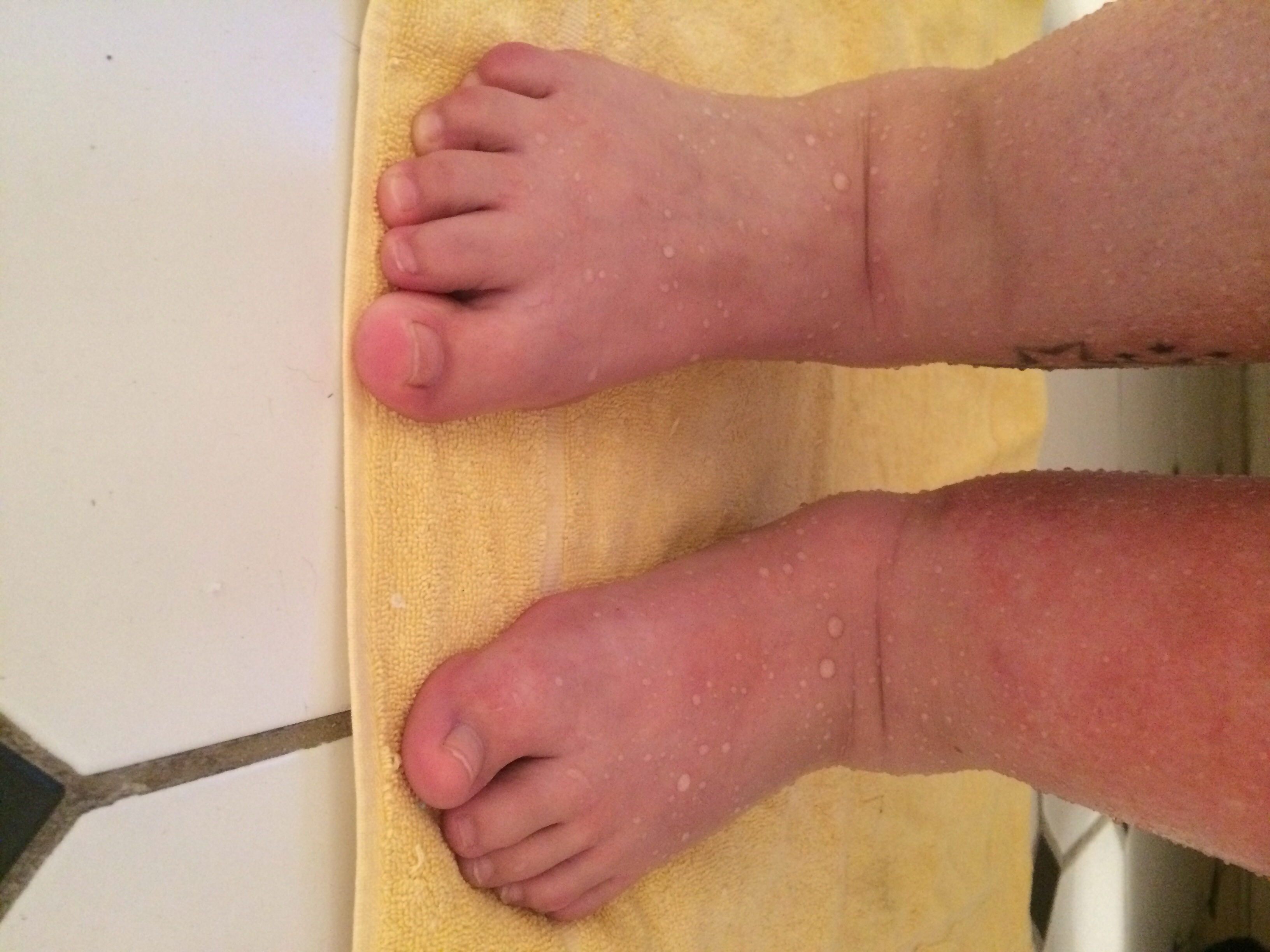 Swelling Feet And Legs — The Bump