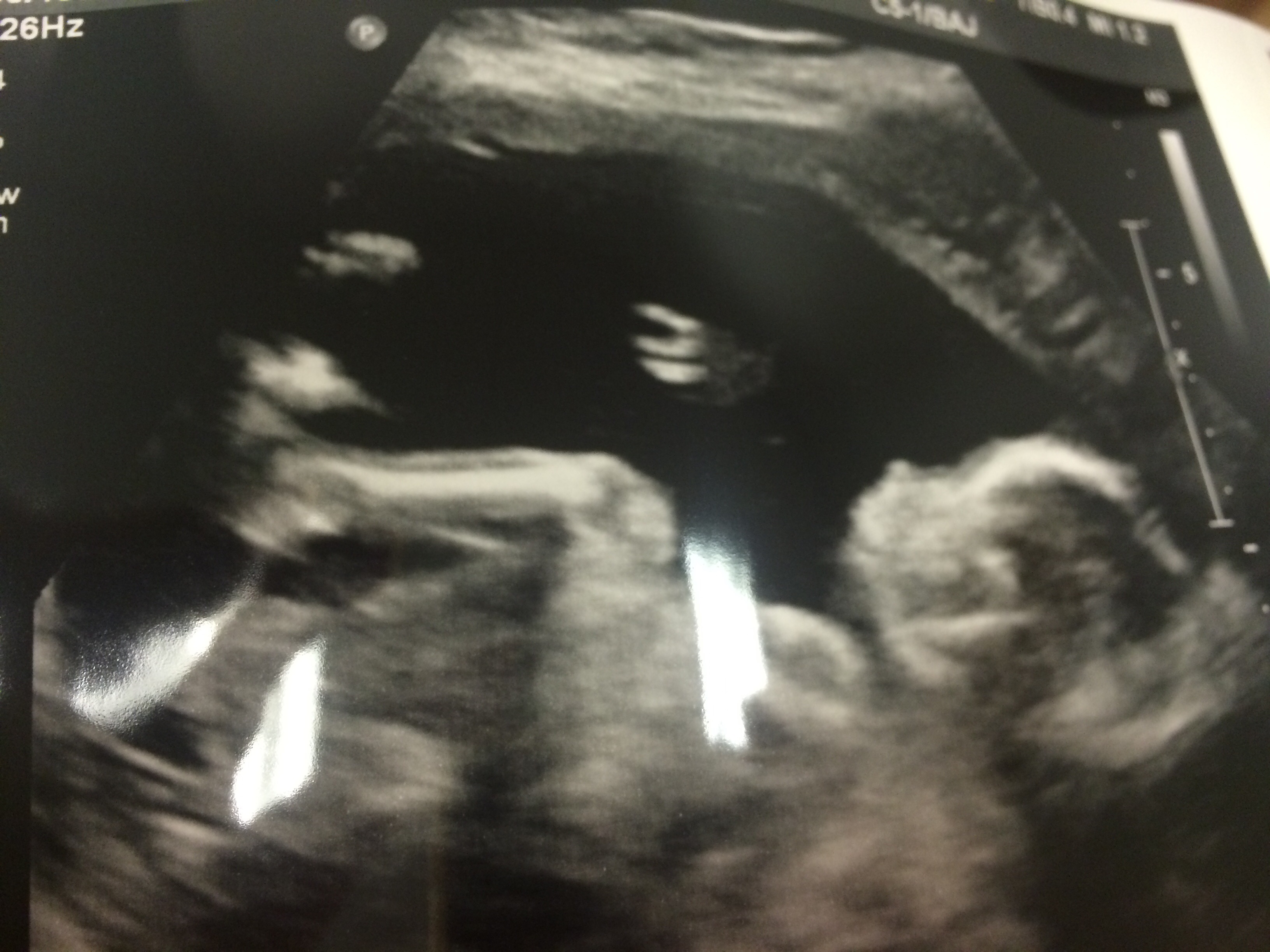 Level 2 ultrasound — The Bump