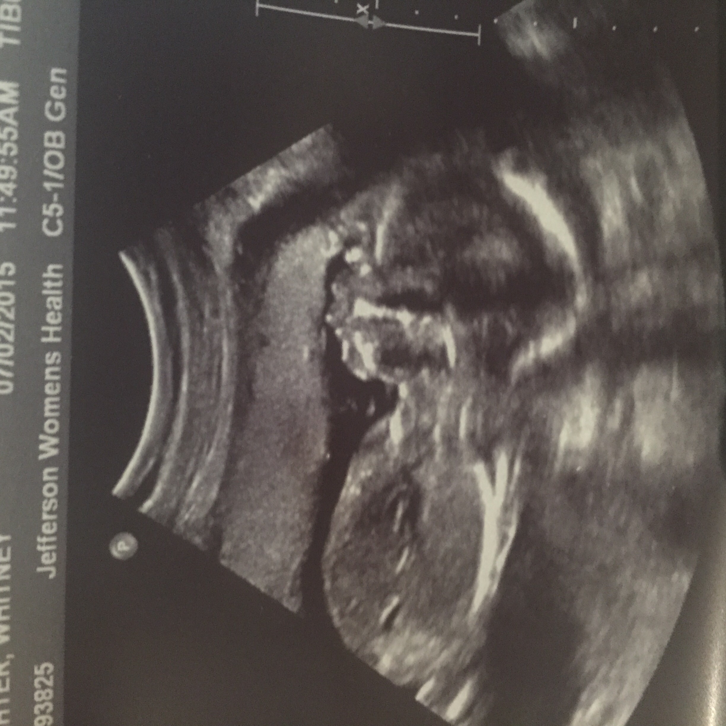 Issues at 20 week scan — The Bump