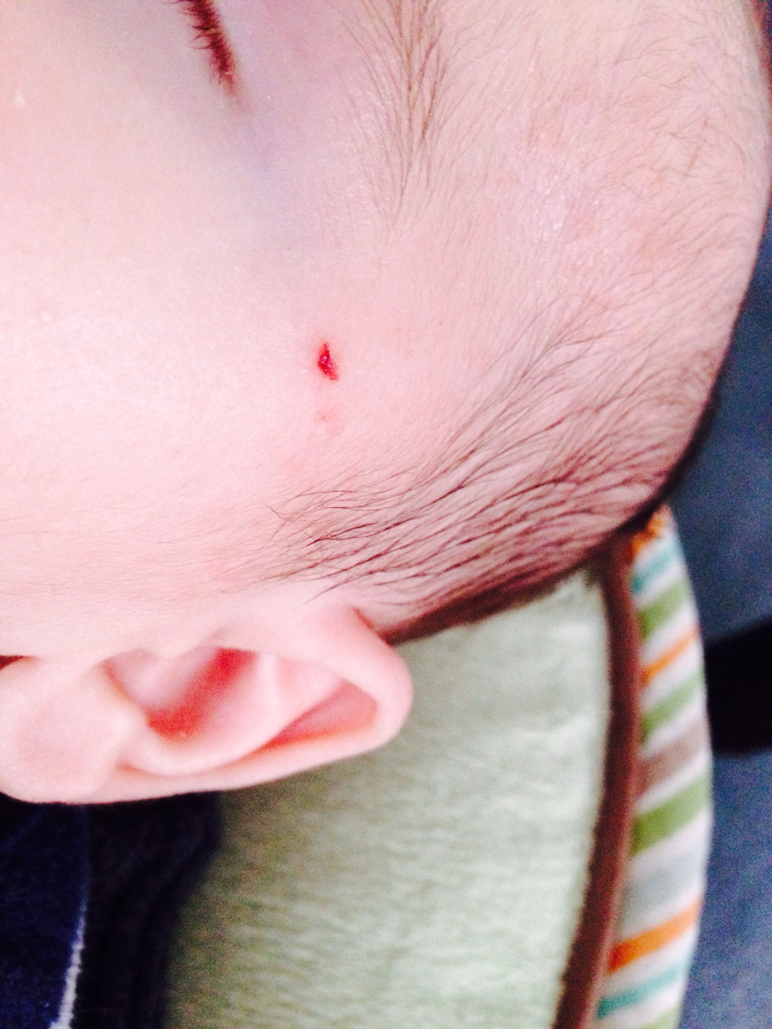 Mark on face (PIP) — The Bump
