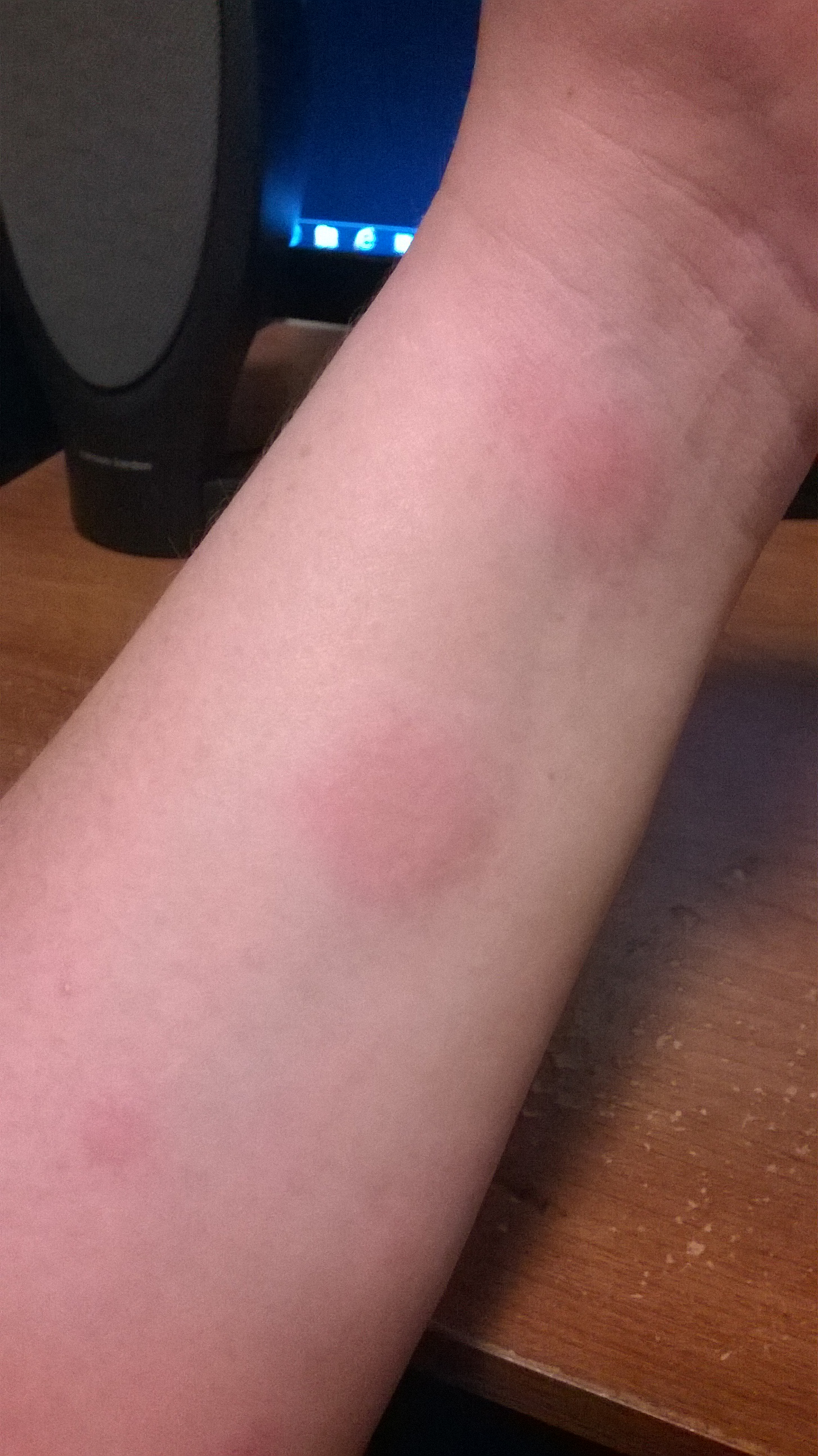 woke up with swollen fingers and weird bumps pictures the bump