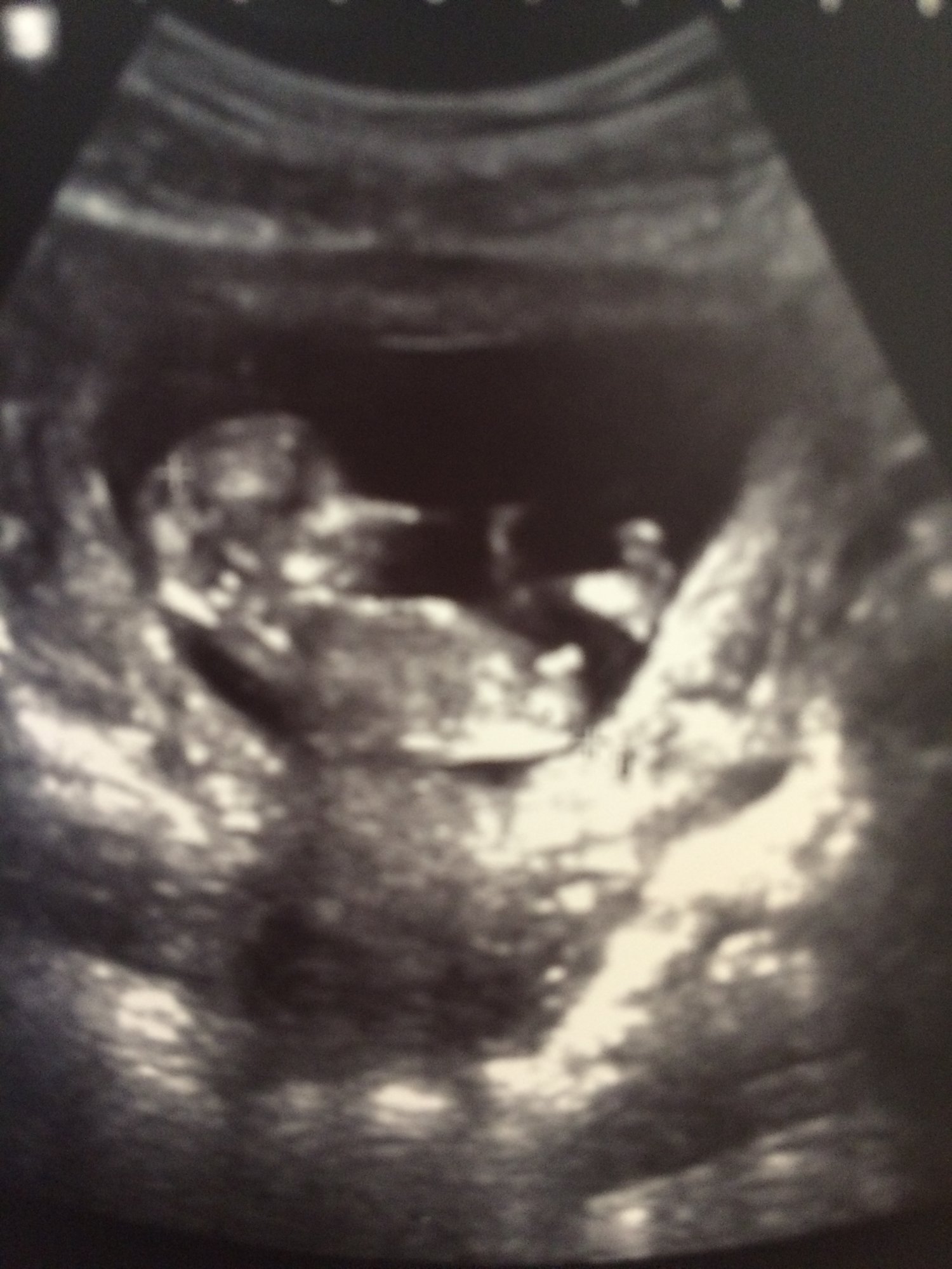 Gender guess from nub shot? — The Bump