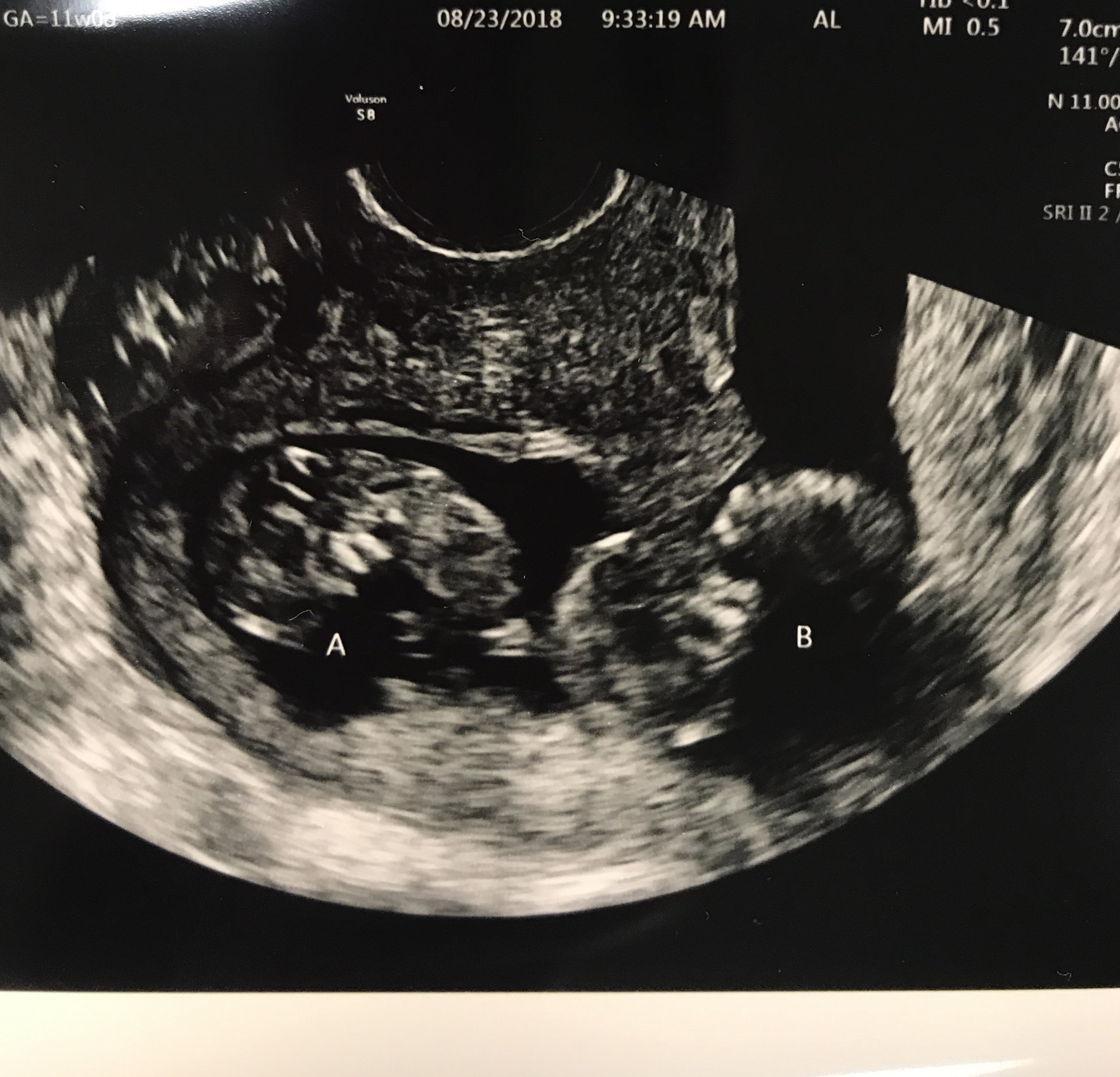 Post Your Ultrasounds Here Page 3 — The Bump