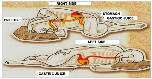severe-heartburn-the-bump