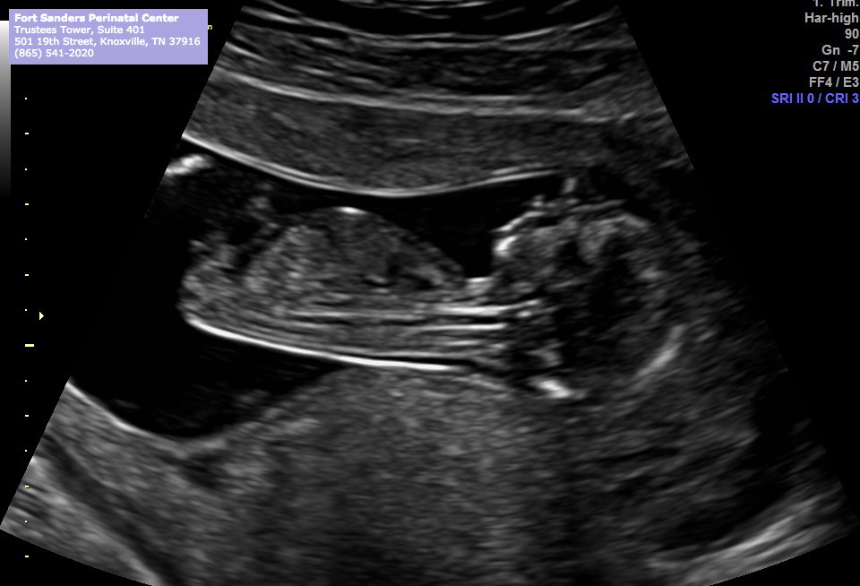 Post Your Ultrasounds Here Page 4 — The Bump