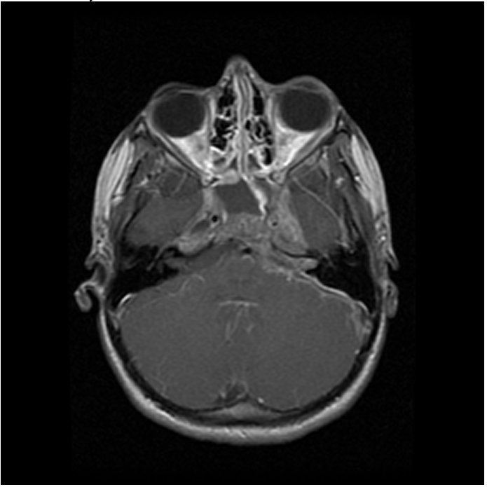 Anatomy Position of eyeballs in head — polycount