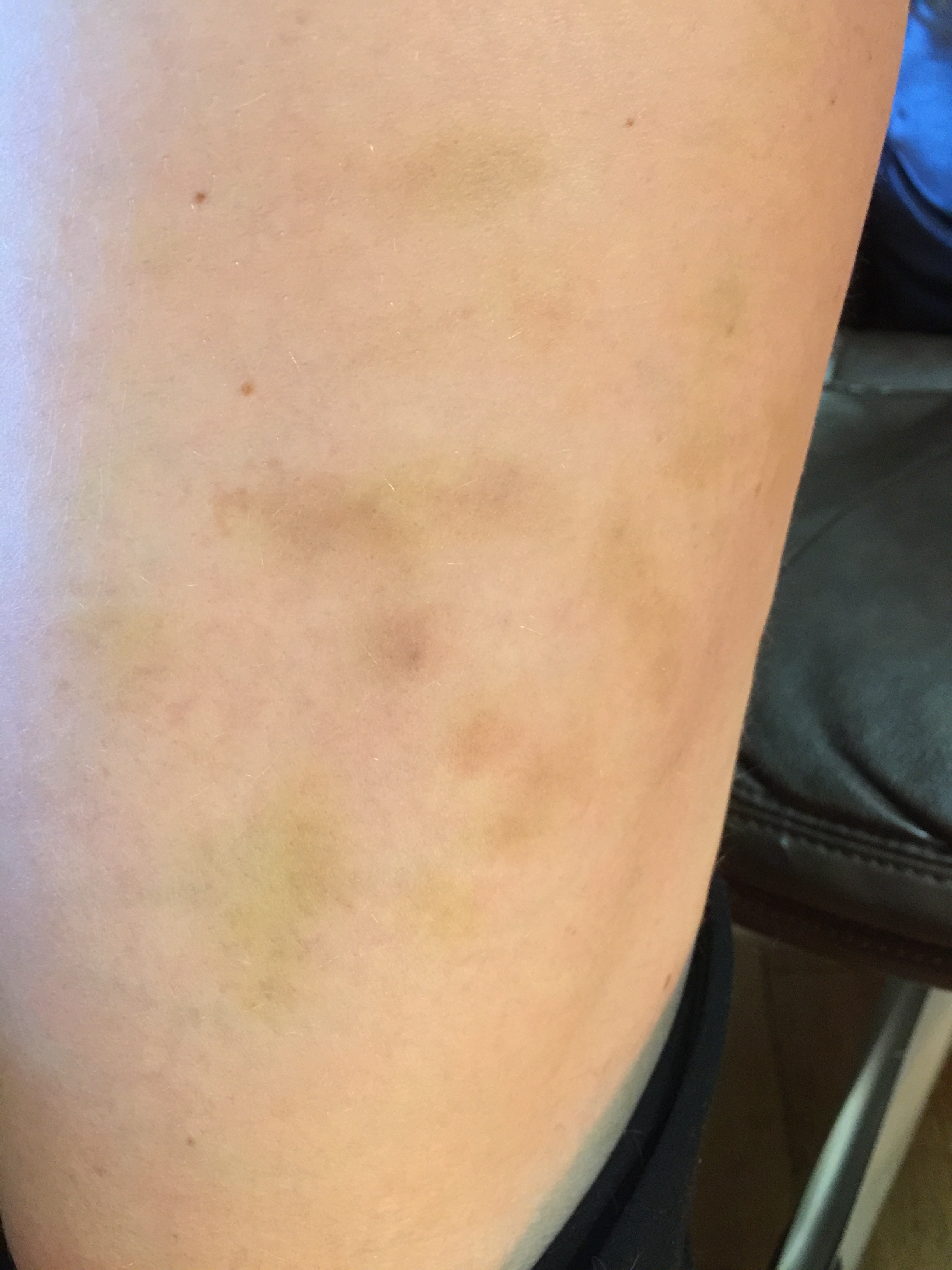 bruise-on-upper-arm