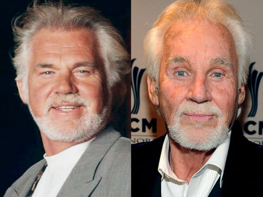kennyrogers-beforeafter_540x405.jpg