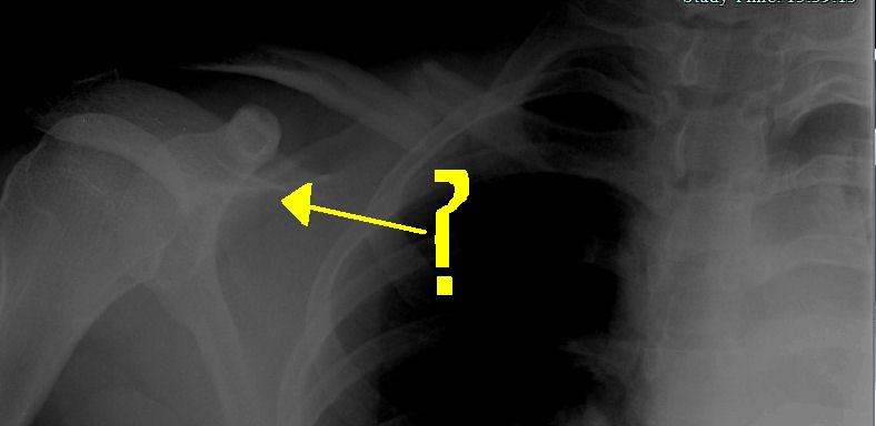 CollarBone1.jpg