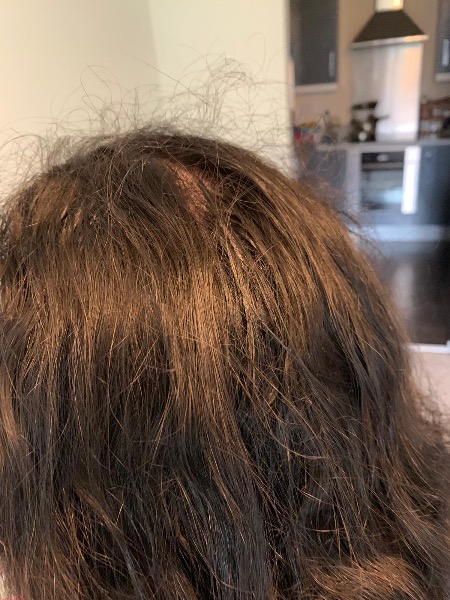 Lyclear Head Lice Treatment Shampoo The Feedback Thread Page 2