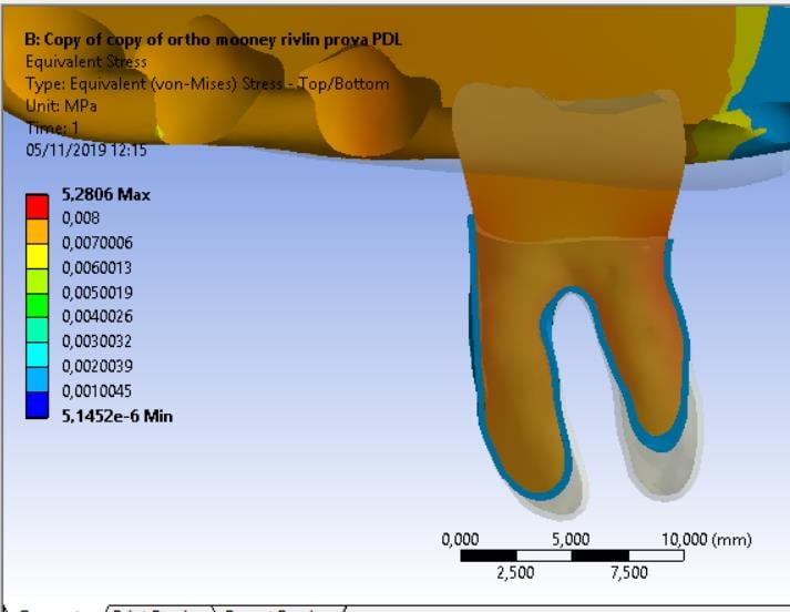 von Mises stress considering on offset of top surface