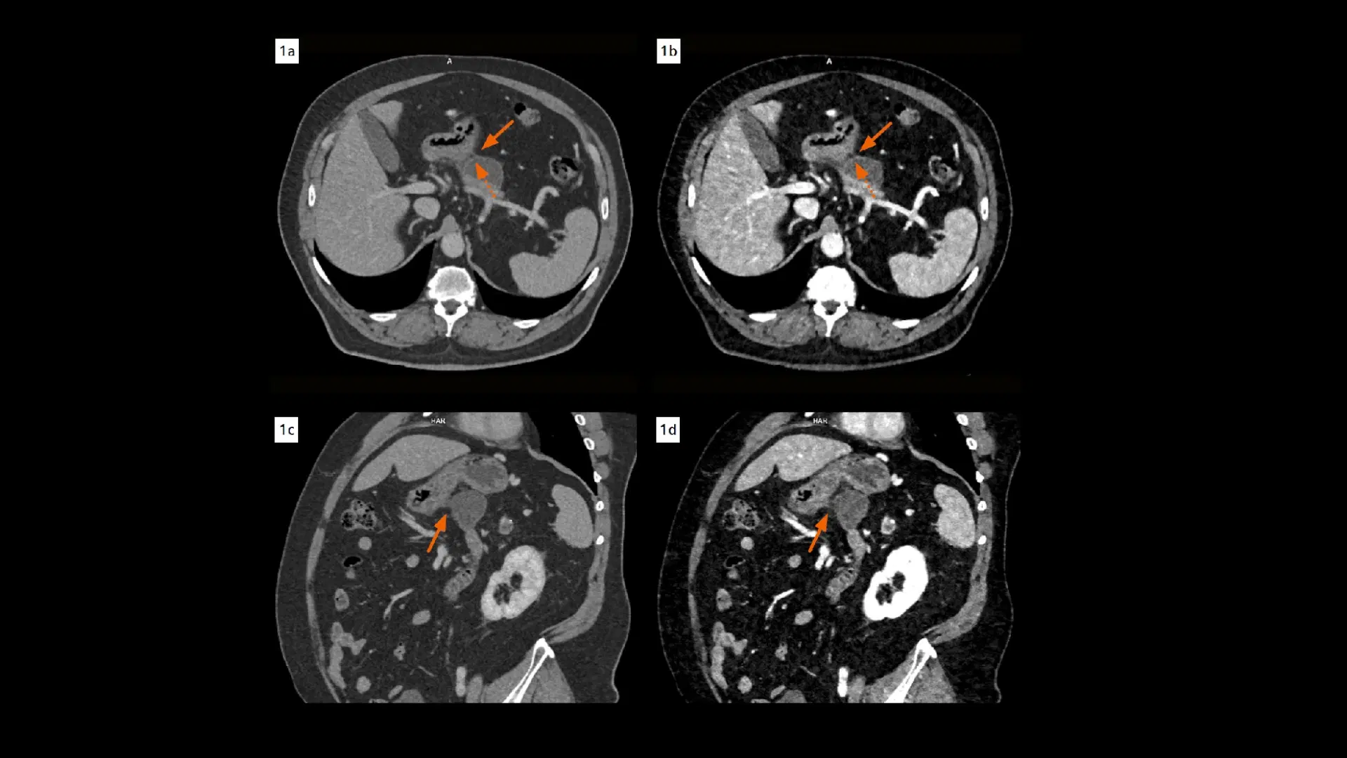 A well-differentiated, invasive ductal adenocarcinoma in the pancreatic ...