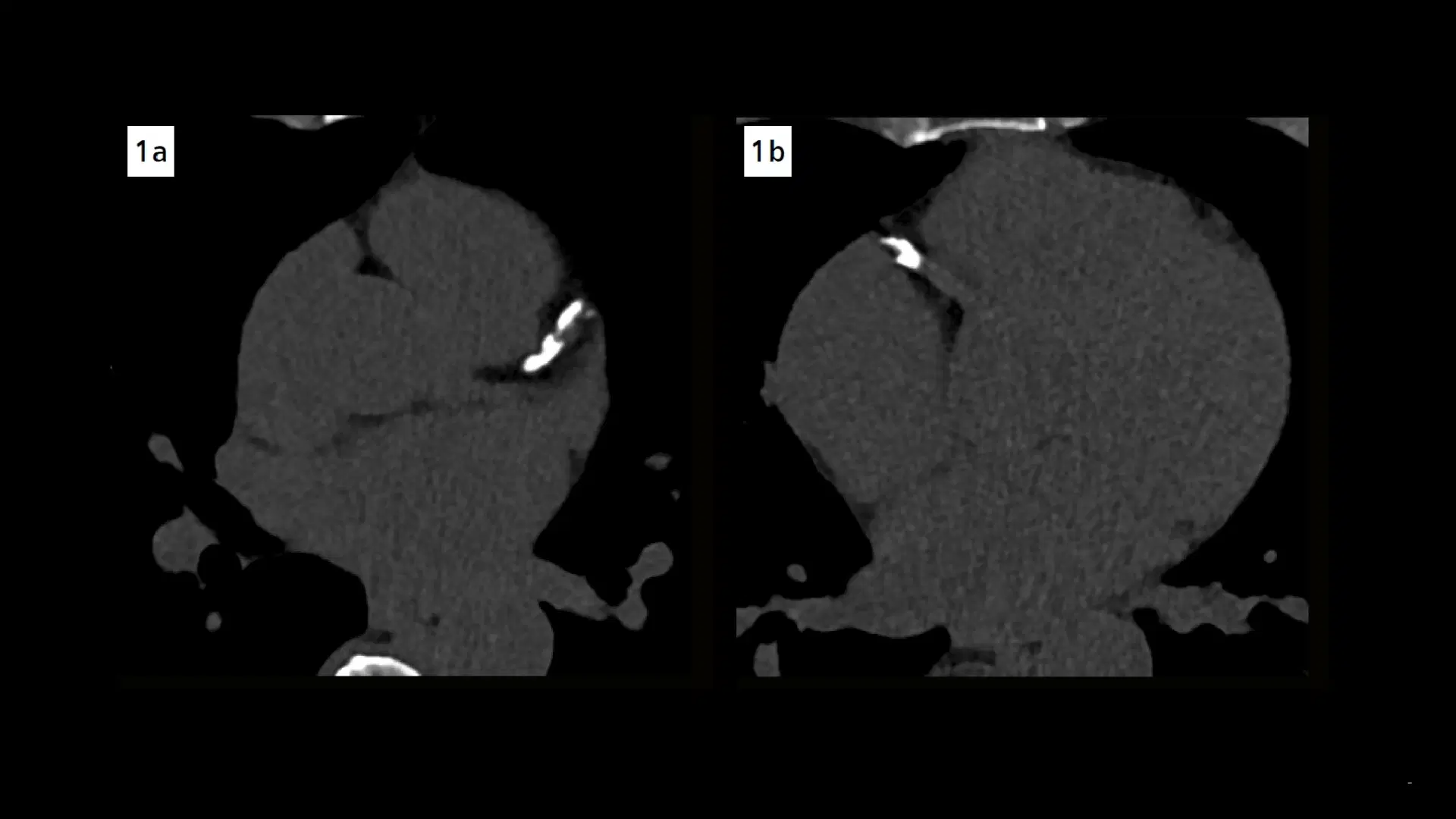 Extensive coronary calcifications with high-risk plaques - NAEOTOM CONNECT